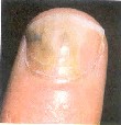 Nail Disease Onychoptosis