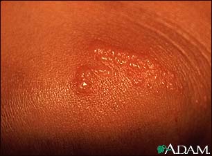 Quia - Primary lesions